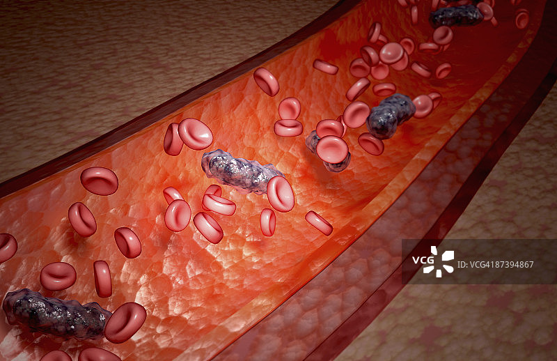 细菌性血液感染图片素材