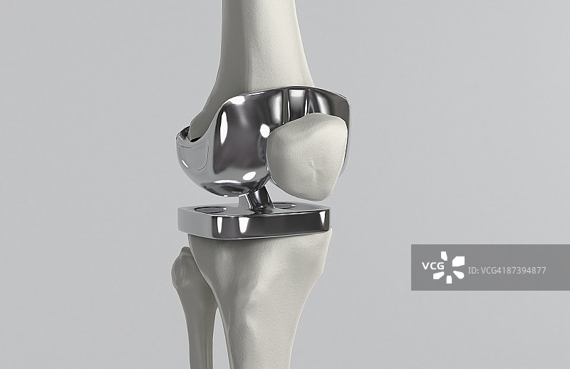 膝关节置换图片素材