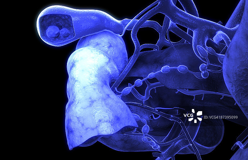 胆结石图片素材