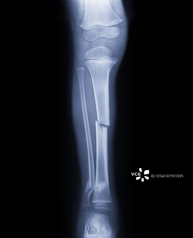 人类腿部骨折图片素材