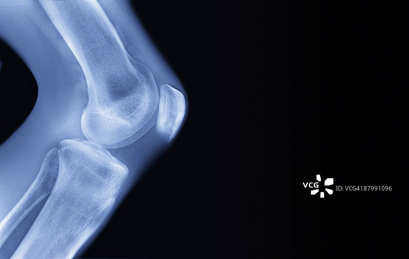 人的膝盖X光片图片素材