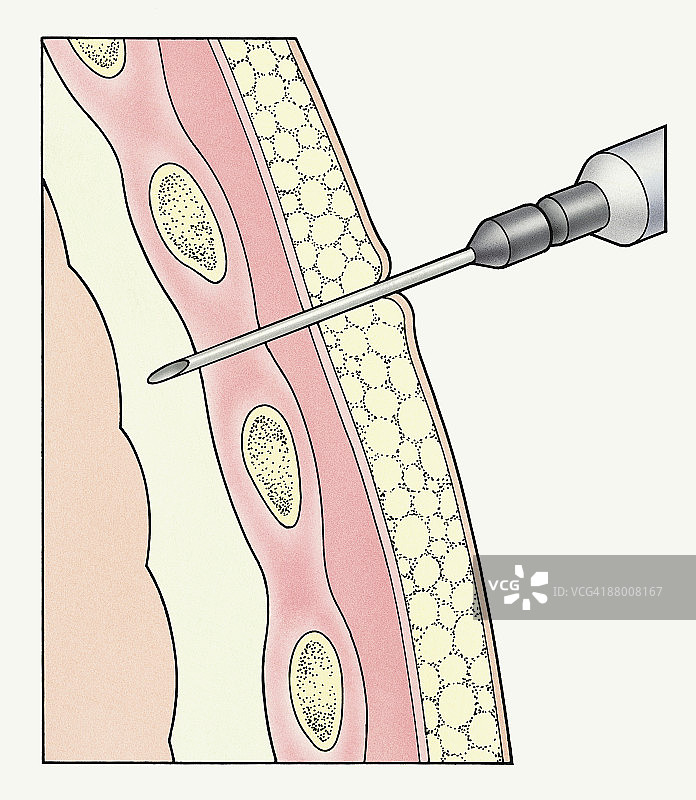 注射器进入人体肺部周围的胸膜抽取样本图片素材