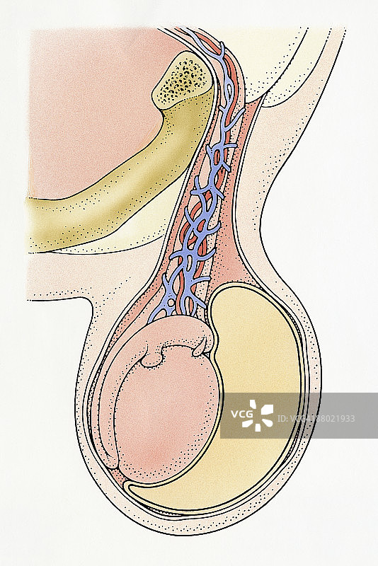 婴儿鞘膜积液睾丸横截面图：精索内透明琥珀色液体环绕睾丸，导致肿胀图片素材