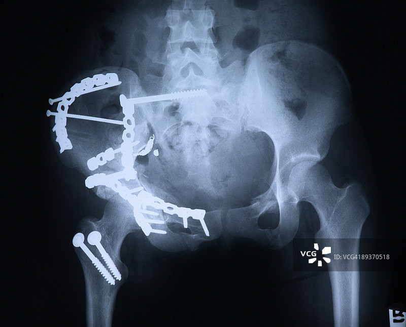 严重的髋部骨折和修复图片素材