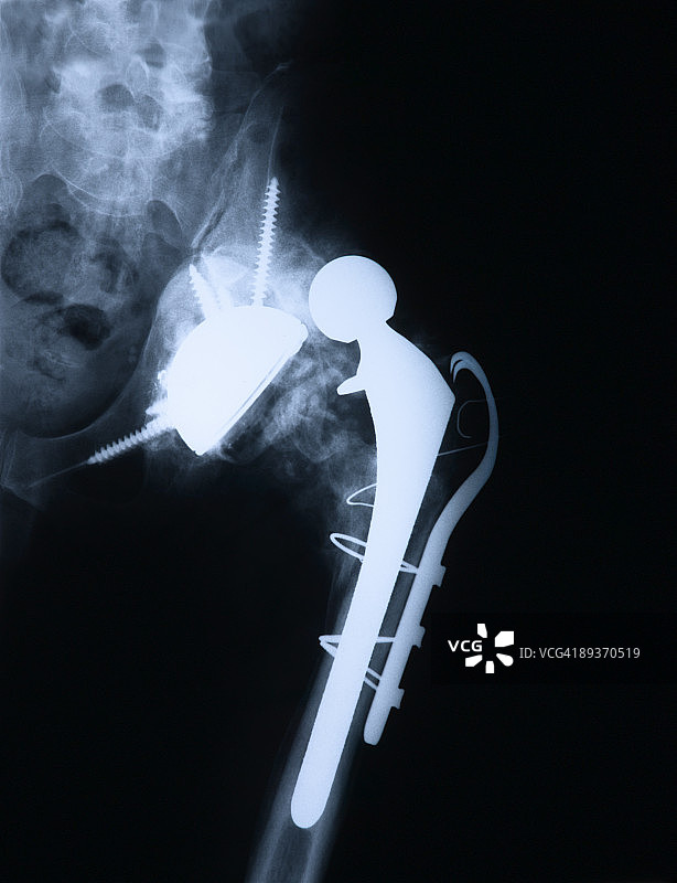 髋关节置换术，已损坏图片素材
