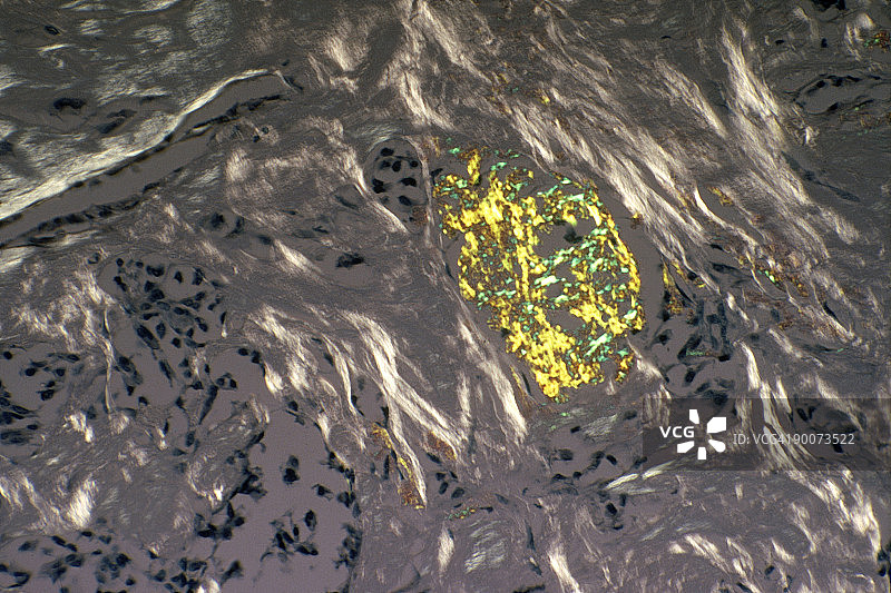 甲状腺髓样癌图片素材