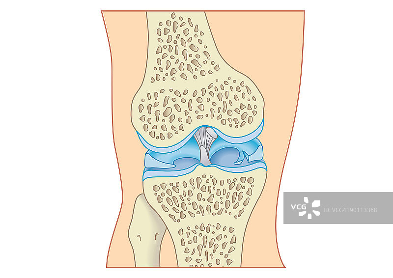 膝盖软骨撕裂的数字剖面图图片素材
