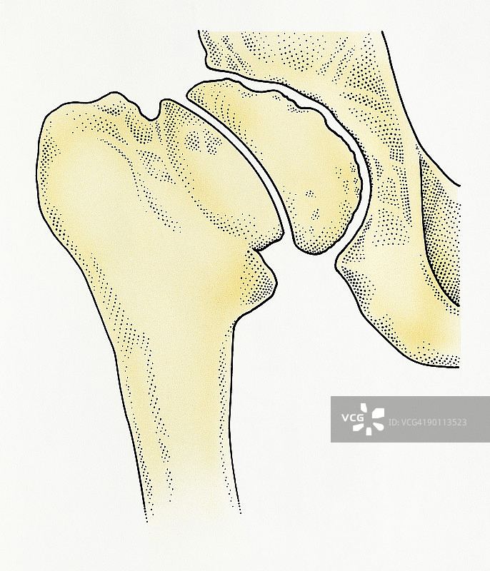 髋关节退行性病变（Perthes病）数字插画图片素材