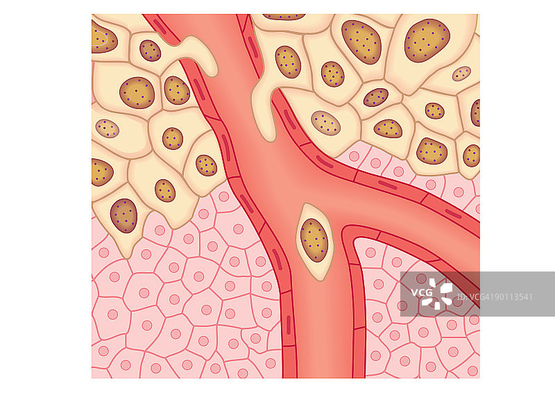 血管壁破裂，原发肿瘤扩张的数字插图图片素材