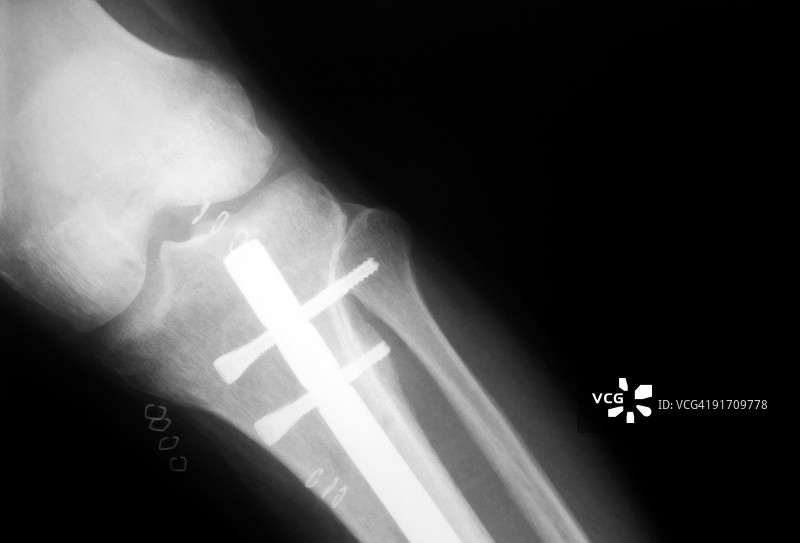 腿部骨折图片素材
