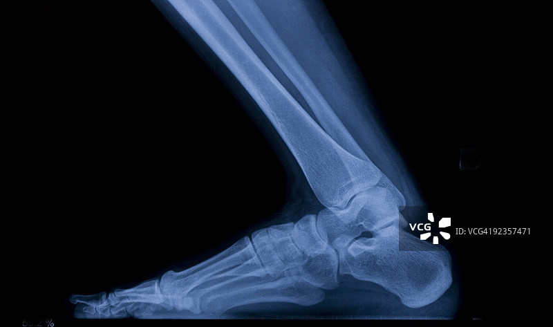 足部X光图像图片素材