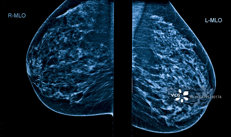 显示左右乳房的乳房X光照片图片素材