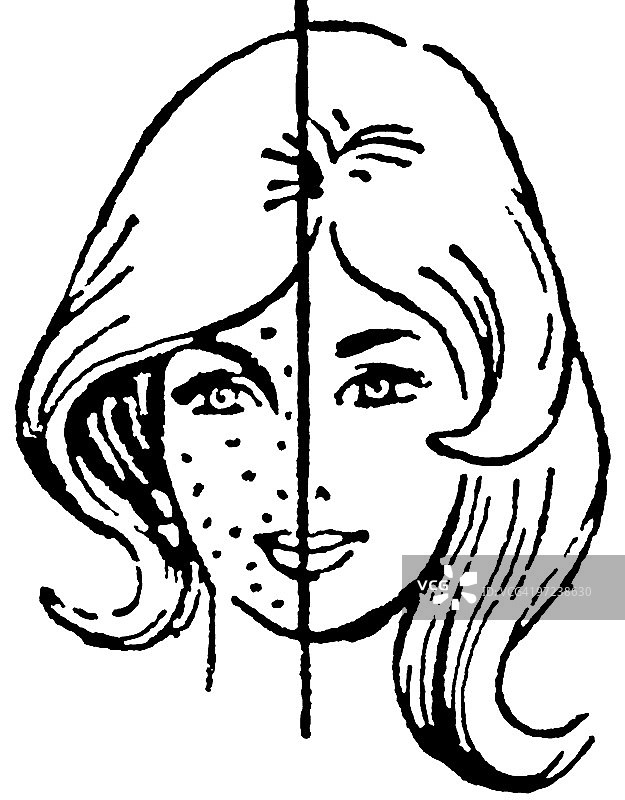 女性痤疮治疗前后对比图片素材
