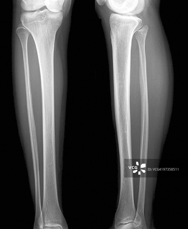 正常的下肢，X光片图片素材