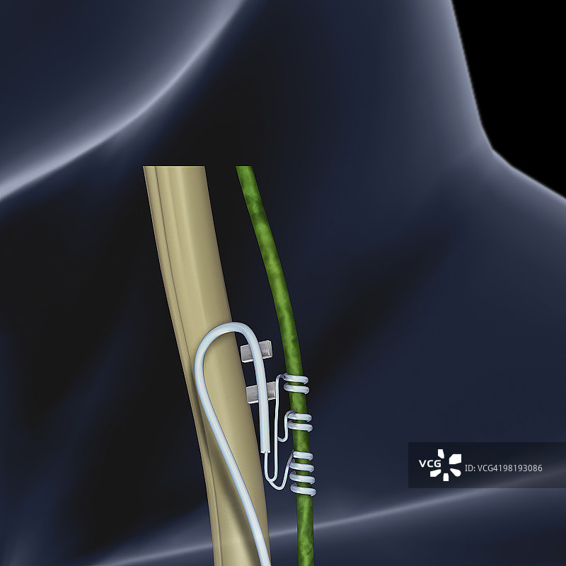 迷走神经周围的电极数字插画图片素材