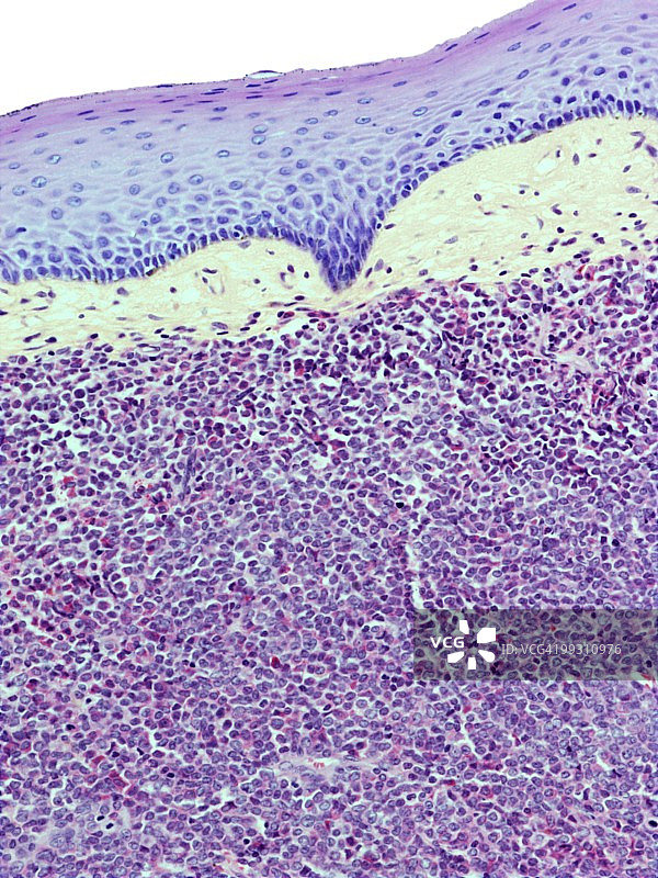 伯基特淋巴瘤光学显微照片图片素材