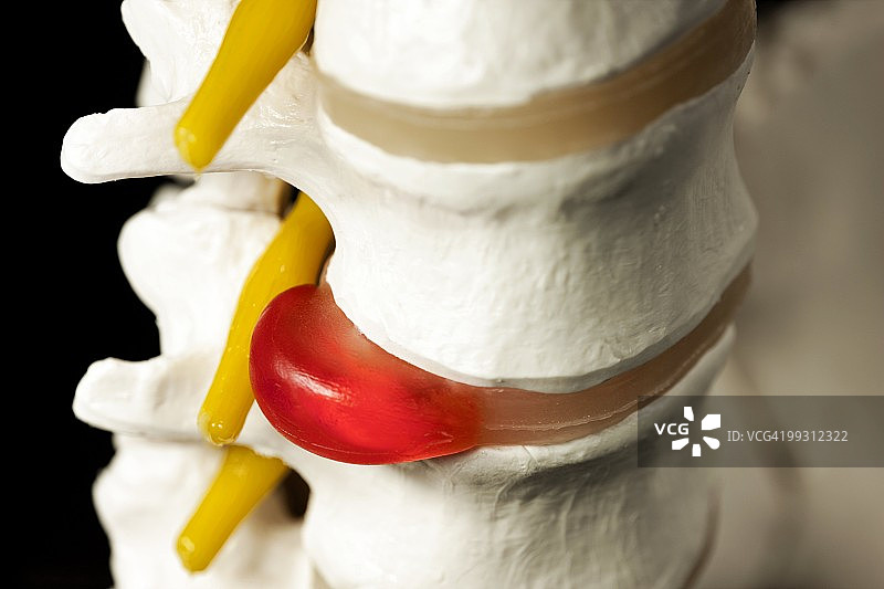 椎间盘滑落图片素材