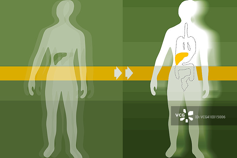 肝移植图片素材