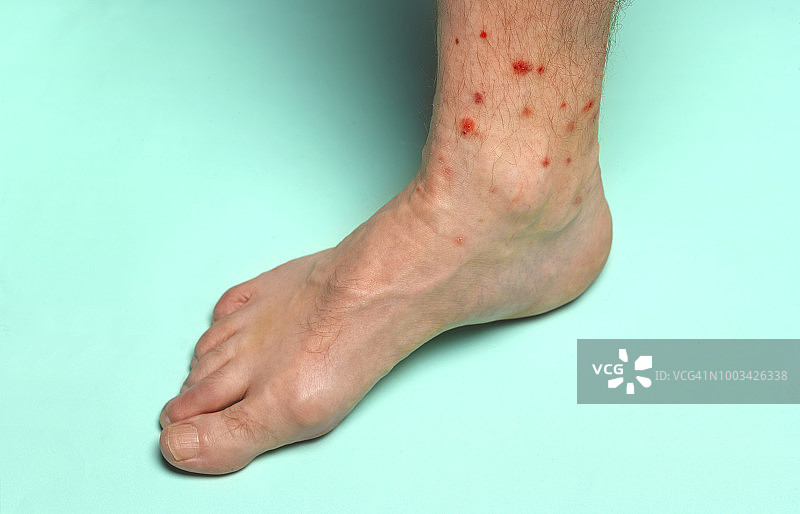 被夏季昆虫叮咬的脚图片素材