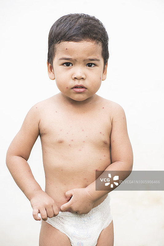 患有水痘的亚洲宝宝图片素材