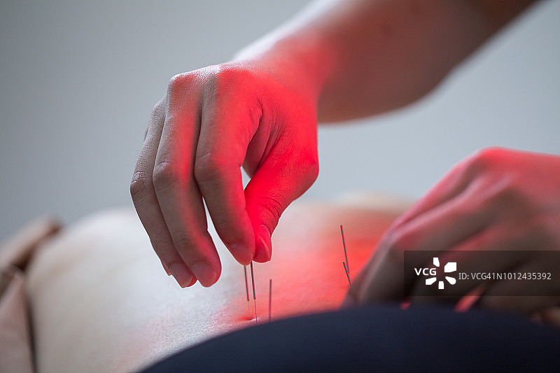 医生使用针灸进行治疗，传统中医图片素材