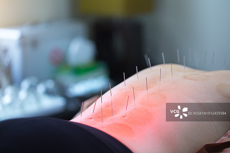 医生使用针灸进行治疗，传统中医图片素材