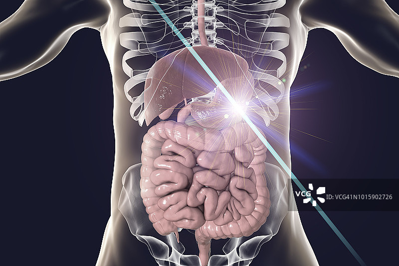 胃癌治疗概念图图片素材