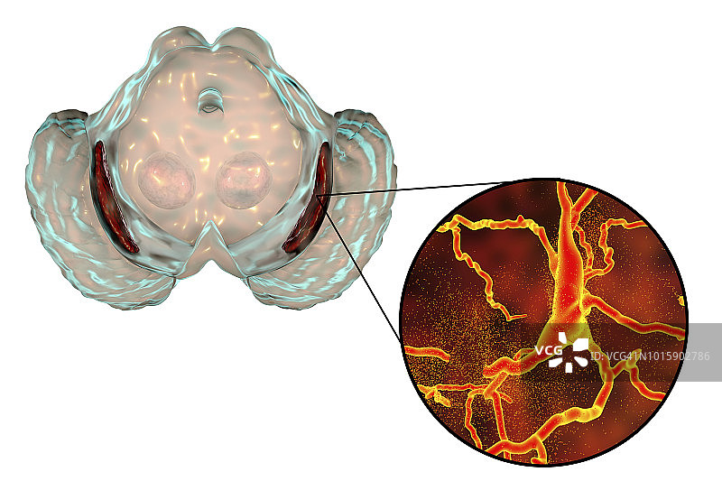 帕金森病黑质示意图图片素材