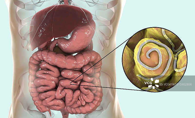 蛲虫感染插图图片素材
