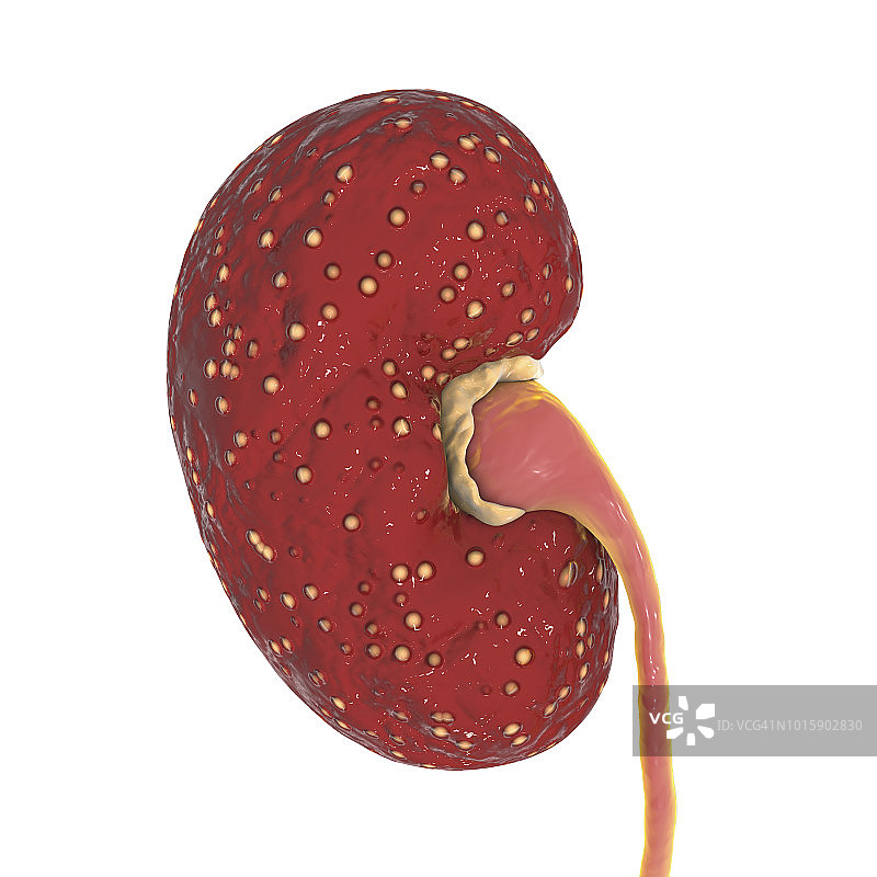 急性肾盂肾炎插图图片素材