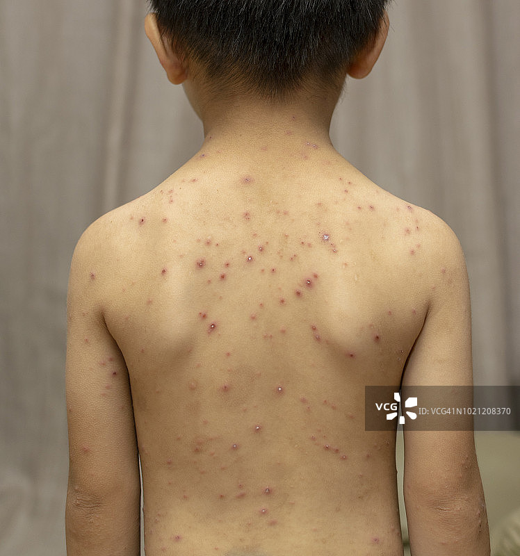 患有水痘的男童 - 背面视角图片素材