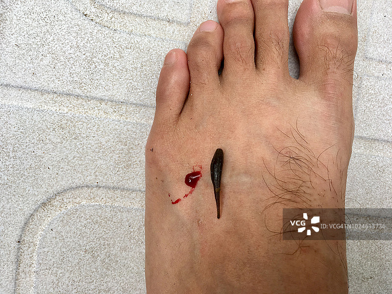 脚上的水蛭咬伤图片素材