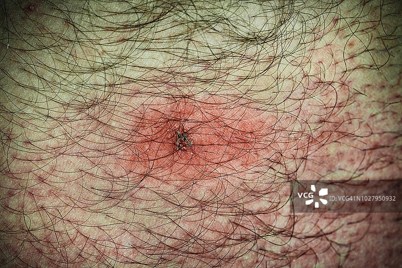 人腿上的鹿蜱叮咬特写图片素材