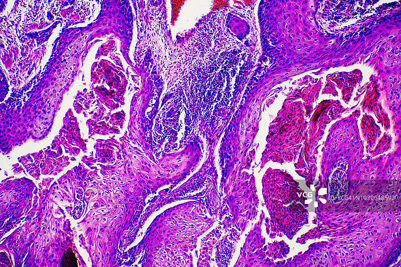 人鳞状细胞癌细胞癌图片素材