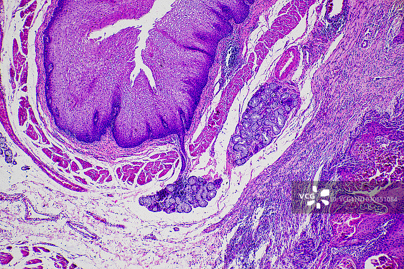 鳞状细胞癌细胞图片素材