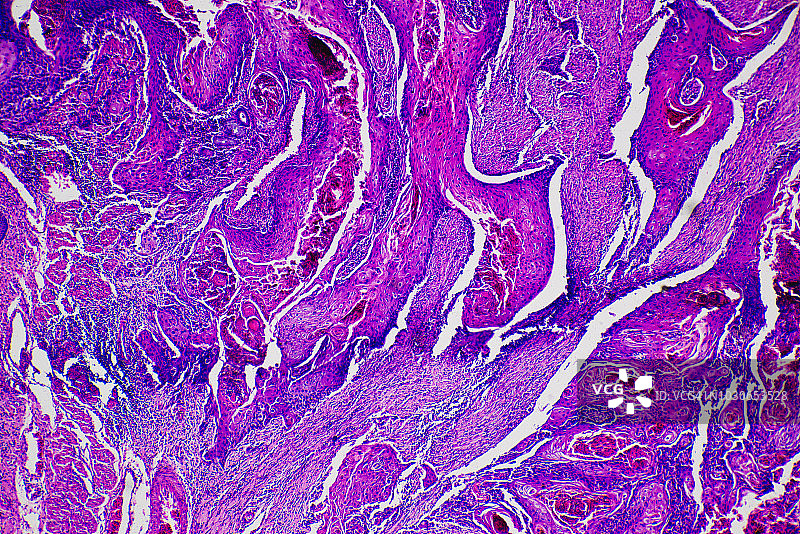 鳞状细胞癌细胞图片素材
