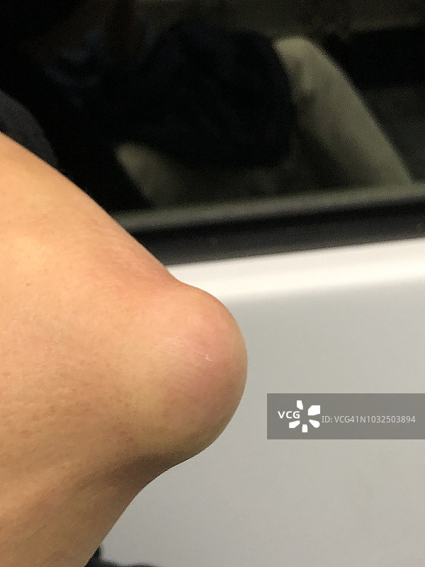 滑囊炎图片素材