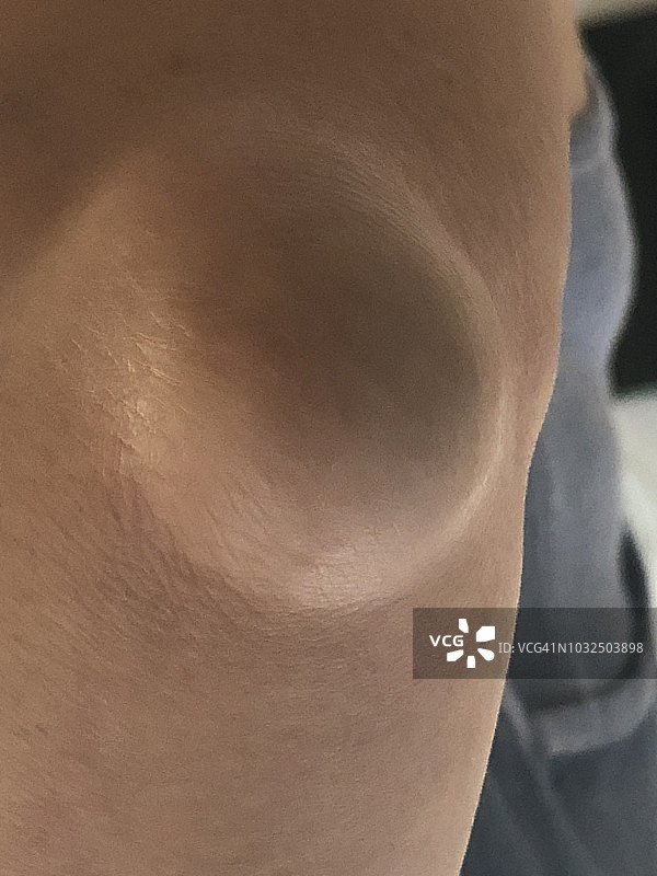 滑囊炎图片素材