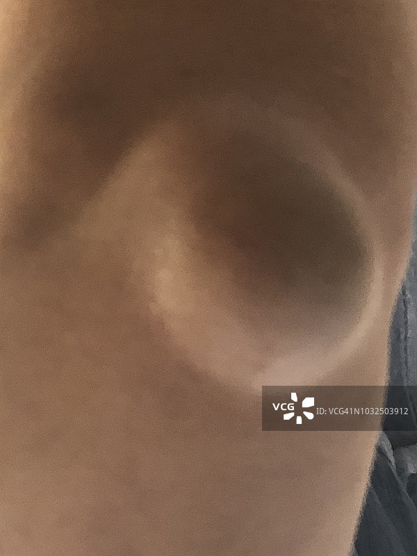 滑囊炎图片素材