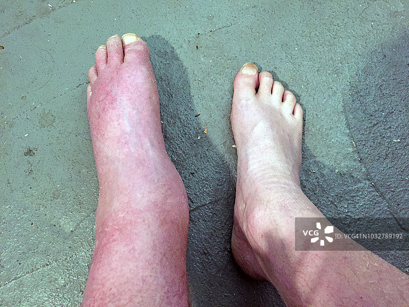 严重水肿的脚图片素材