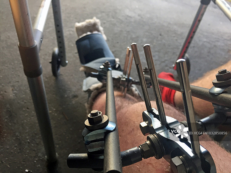 腿部骨折的男人接受外固定治疗图片素材