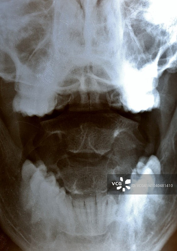 下颌骨解剖图像图片素材