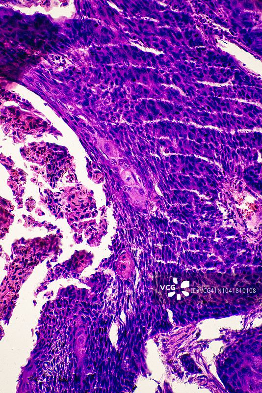 人类皮肤癌肿瘤组织图片素材