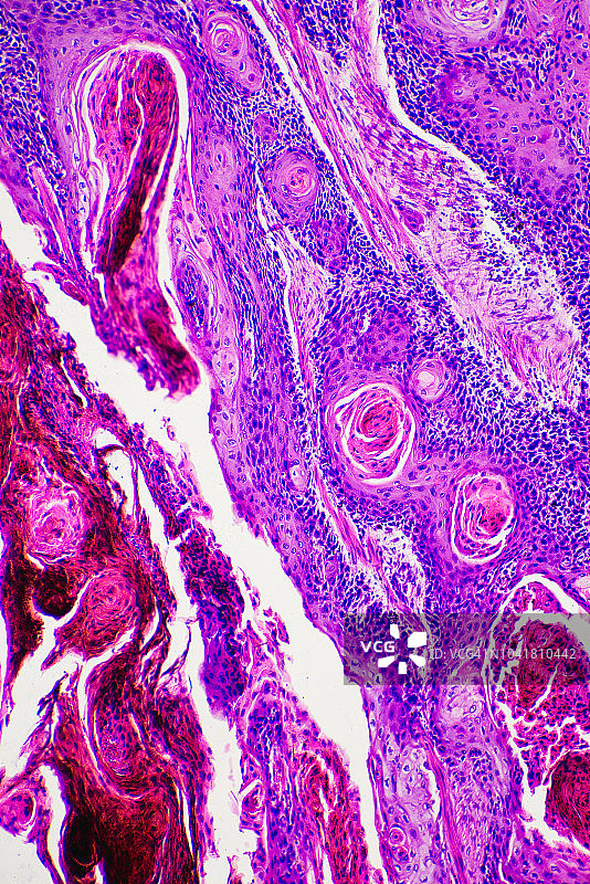 人皮肤癌细胞的浅色显微照片图片素材