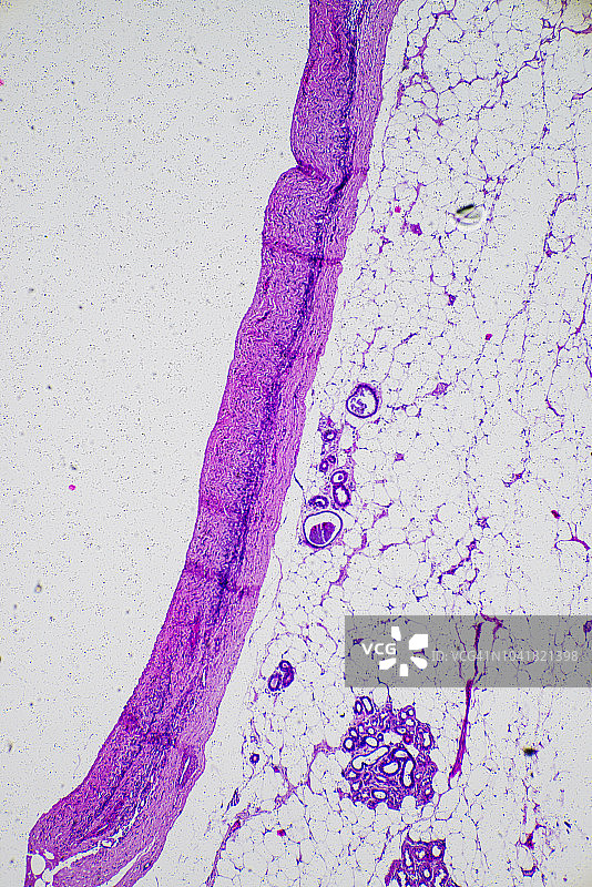 人体肿瘤脂肪组织显微照片图片素材