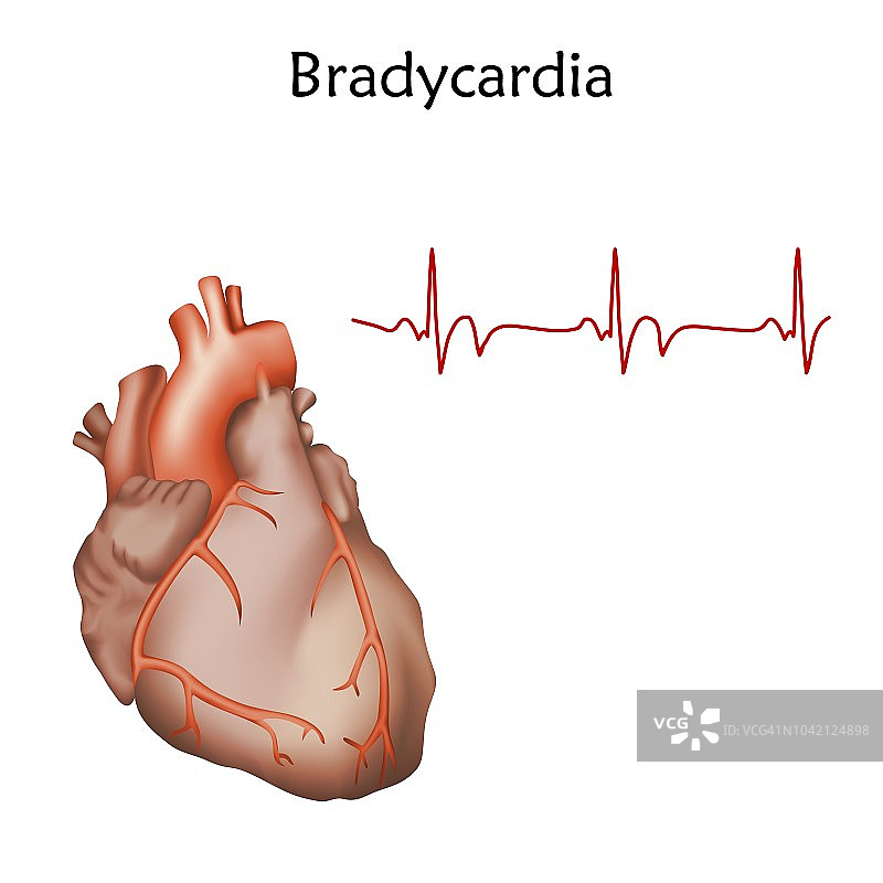 心动过缓插图图片素材