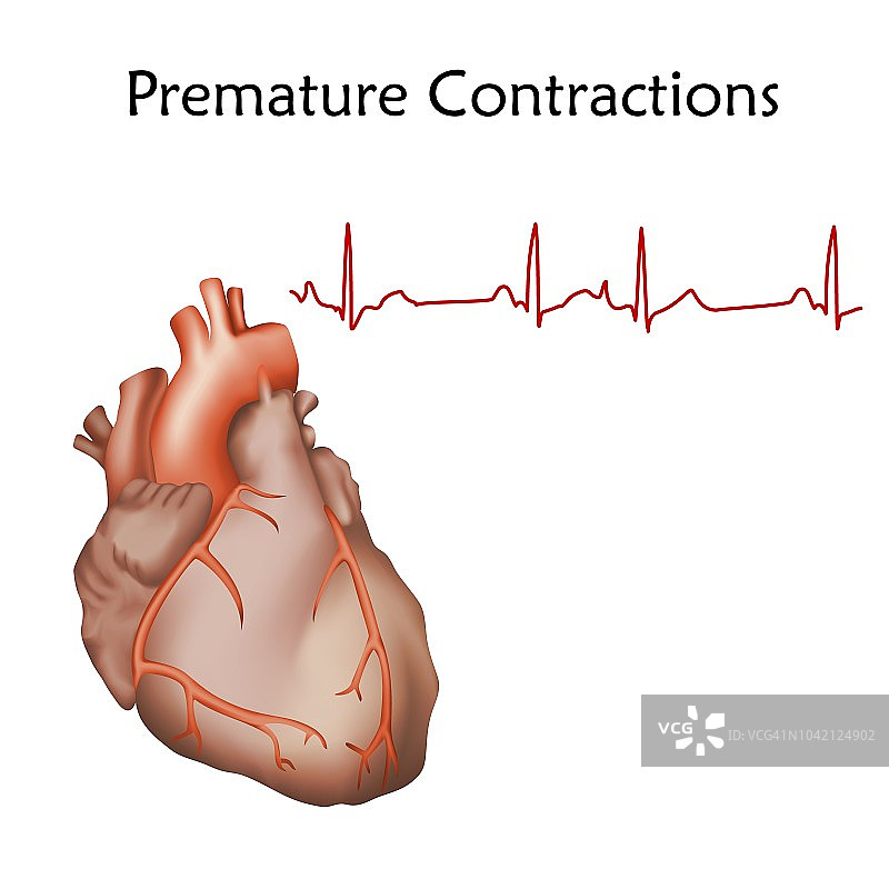 早搏，图示图片素材