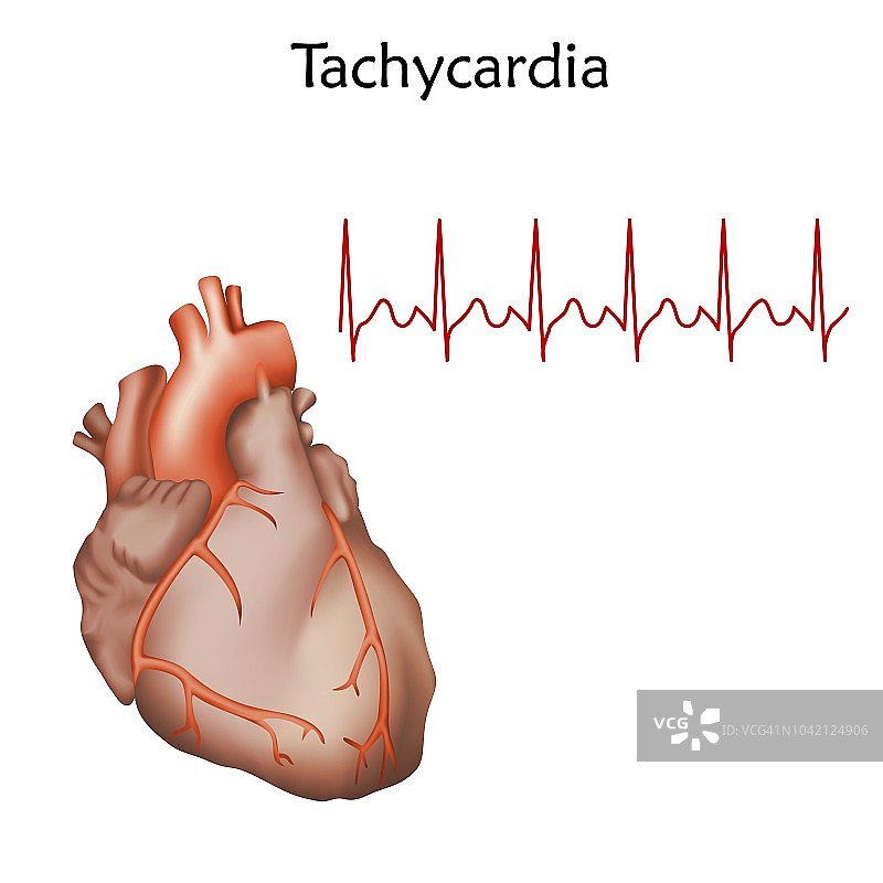 心动过速插图图片素材