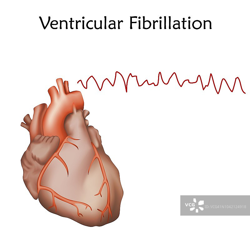 心室颤动插图图片素材
