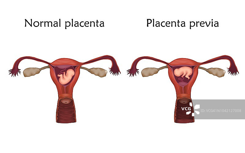 前置胎盘示意图图片素材